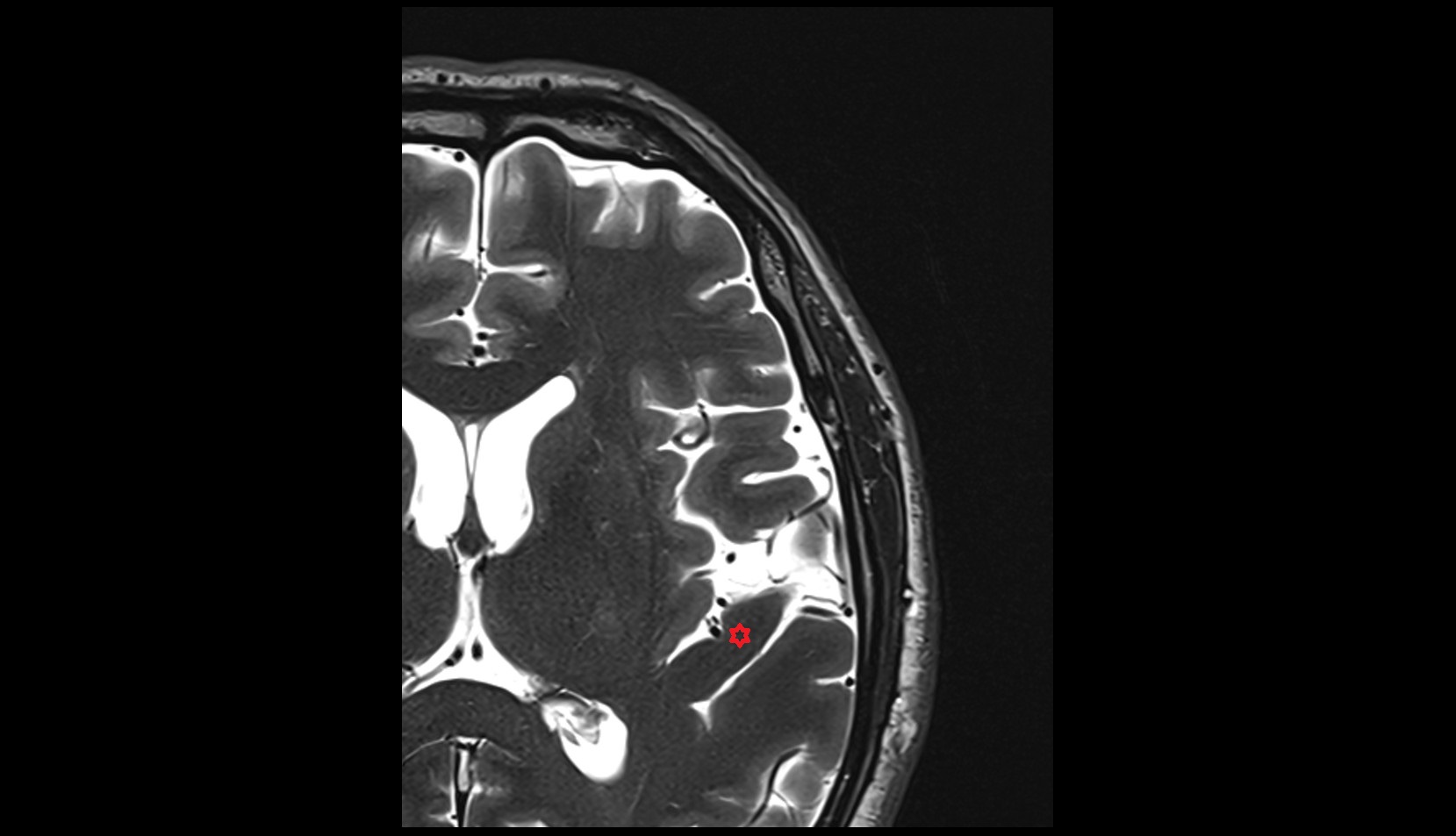 Transverse temporal gyrus (Heschl) MRI 3T axial image