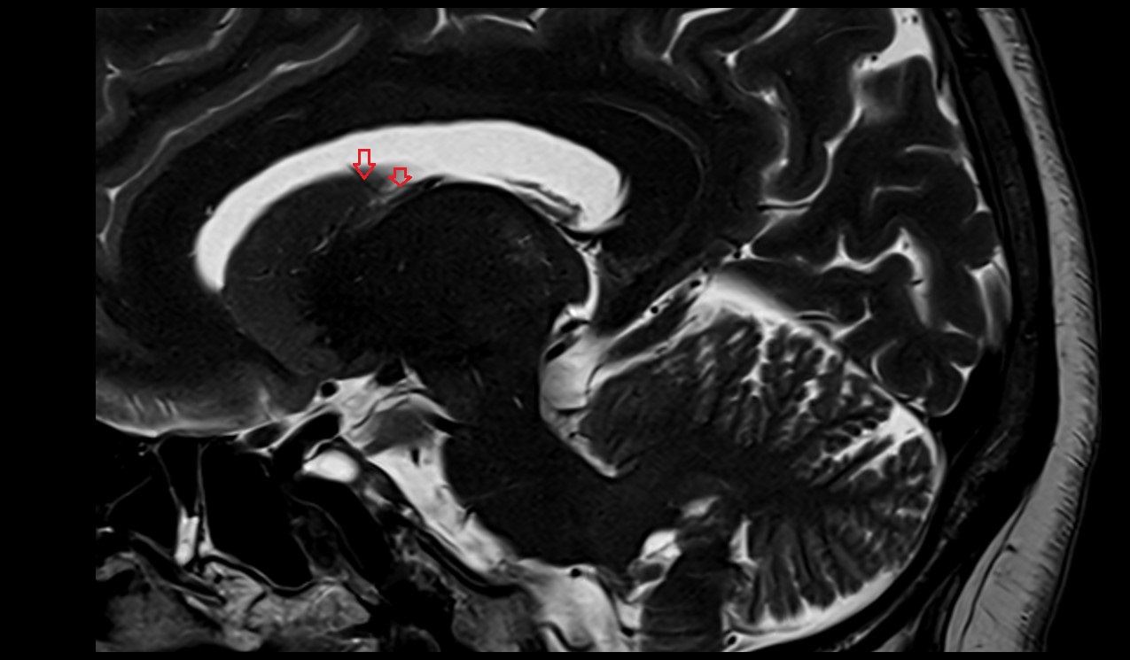 Transverse veins of caudate nucleus MRI 3T sagittal image