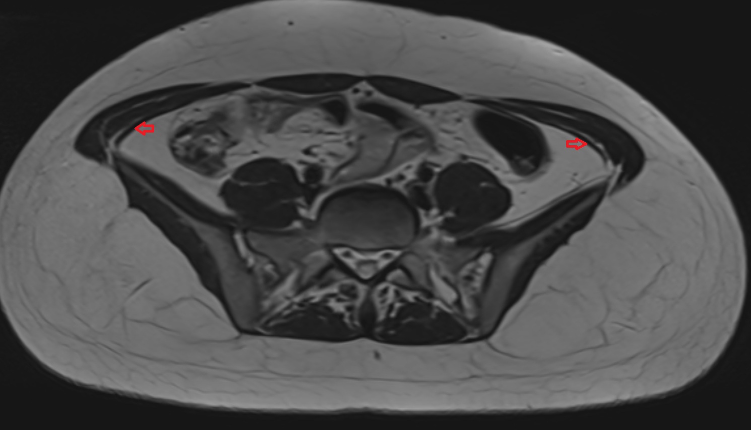 Transversus abdominis muscle MRI axial image anatomy  image -img-00000-00000