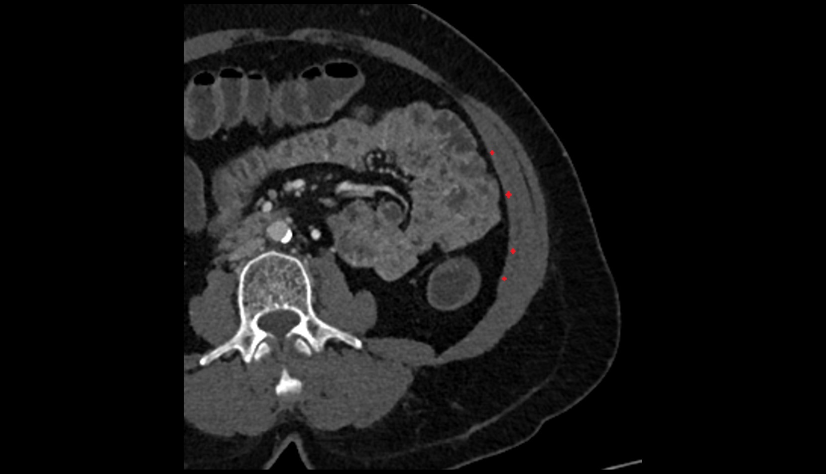 Transversus abdominis muscle ct axial image