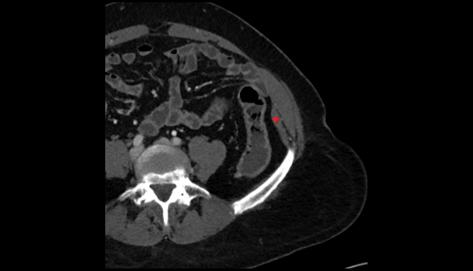 Transversus abdominis muscle ct axial image 1