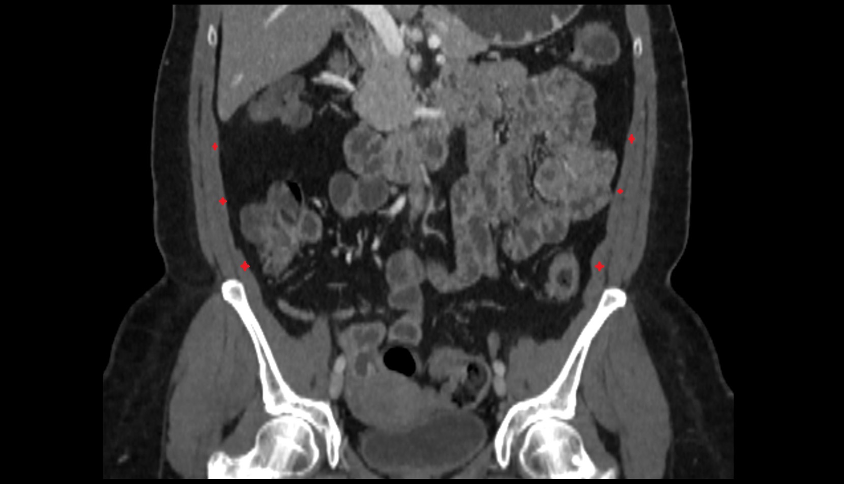 Transversus abdominis muscle ct coronal image