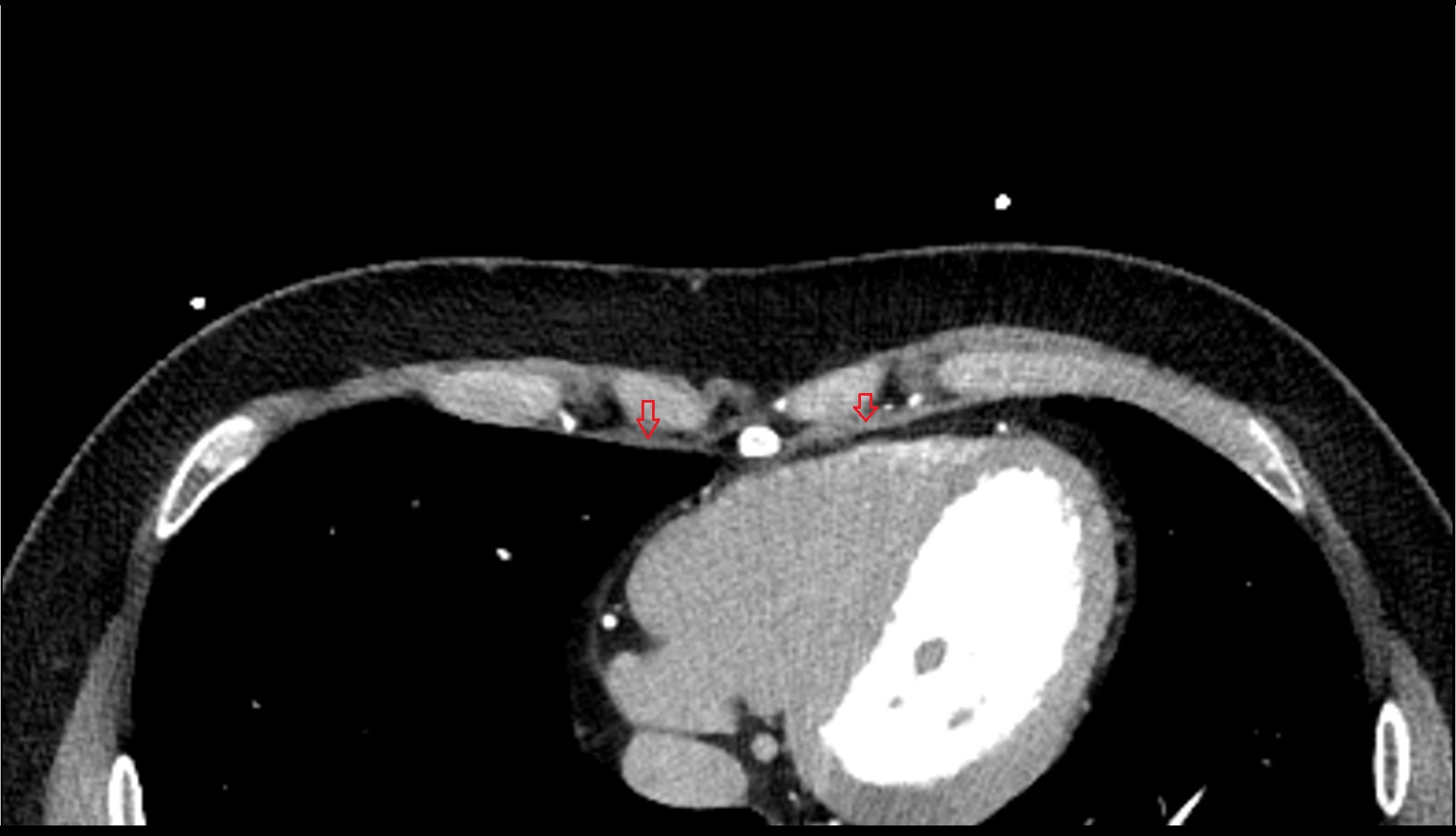 Transversus thoracis muscle CT axial image