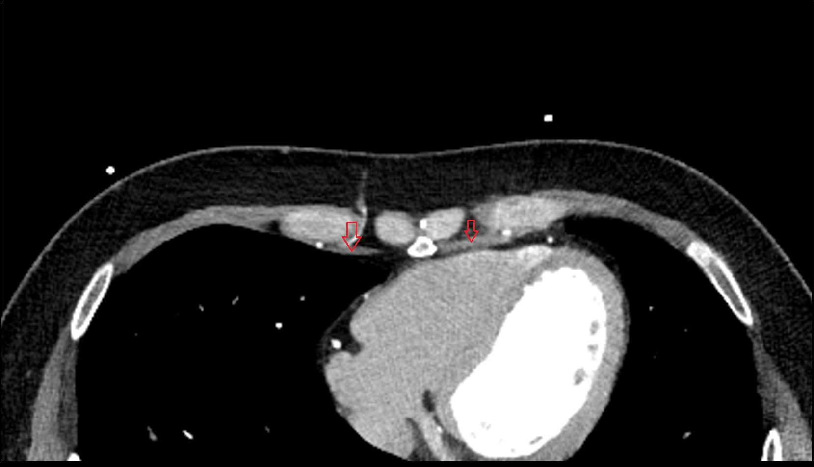 Transversus thoracis muscle CT axial image 1