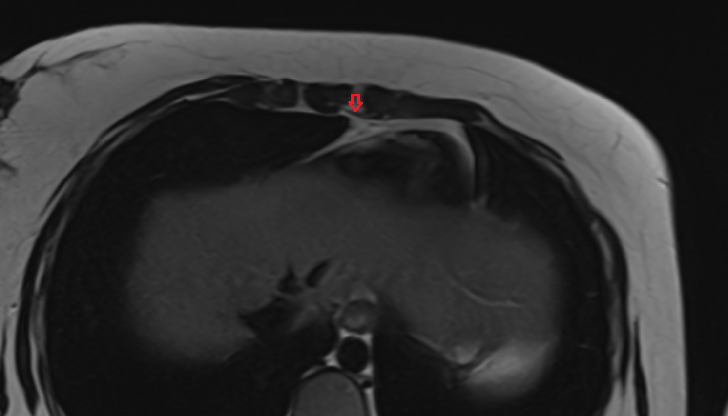 Transversus thoracis muscle CT axial image  MRI axial  image anatomy  image -img-00000-00000