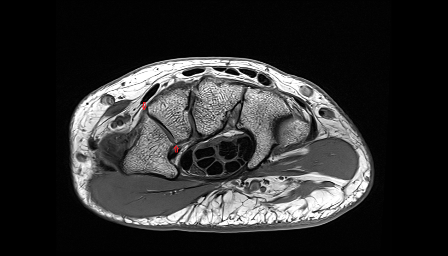 Trapeziotrapezoid ligament axial cross sectional anatomy 3T MRI AI enhanced radiology image-img-00000-00000