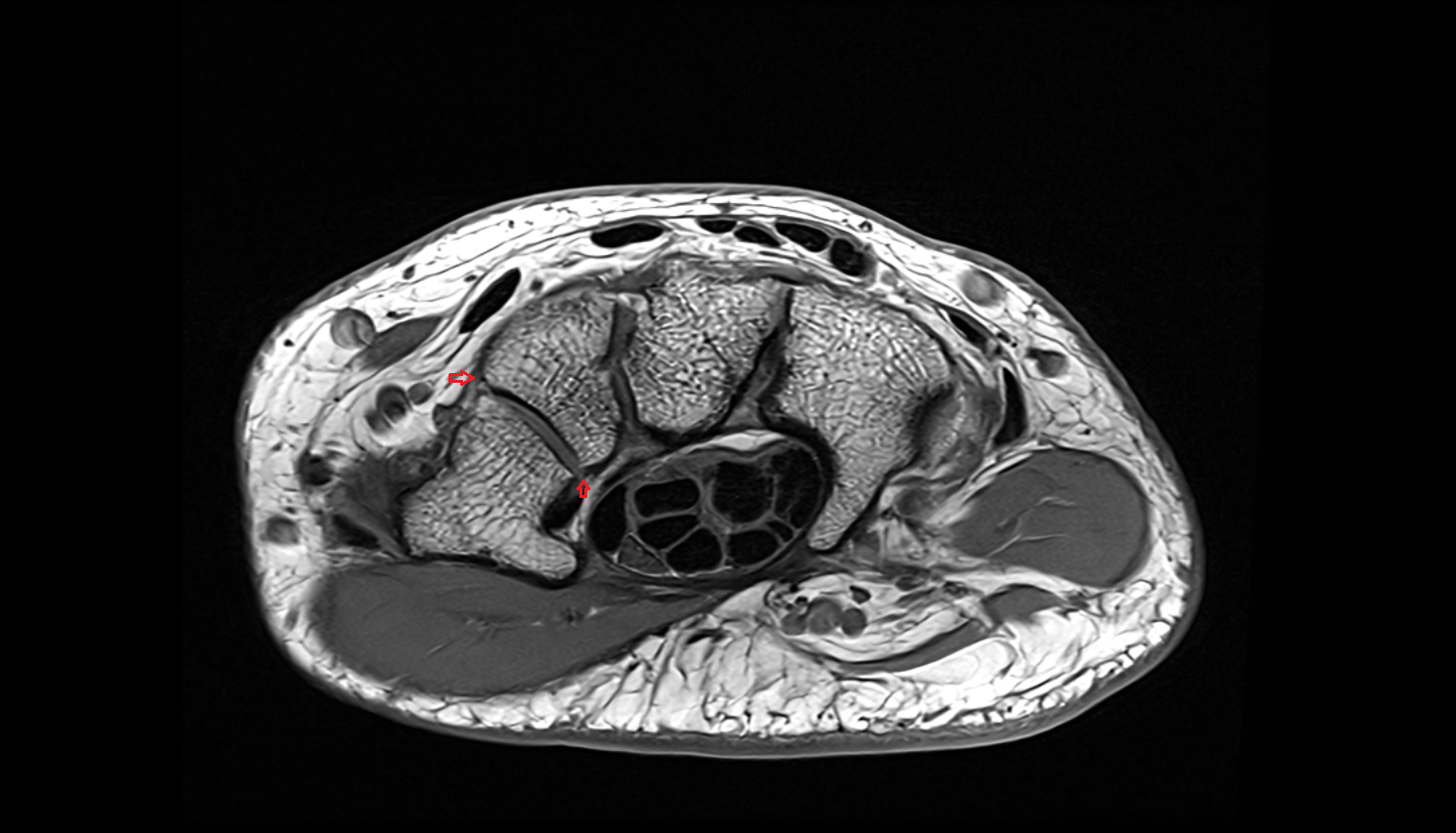 Trapeziotrapezoid ligament axial cross sectional anatomy 3T MRI AI enhanced radiology image-img-00000-00000_00001