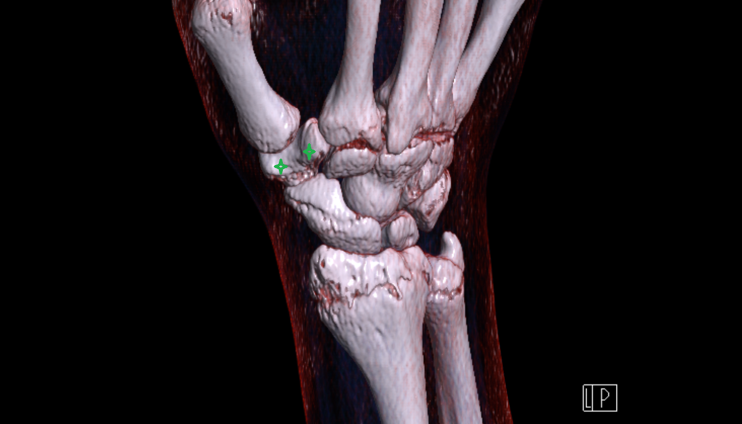 Trapezium bone CT 3D VRT image -img-00000-00000