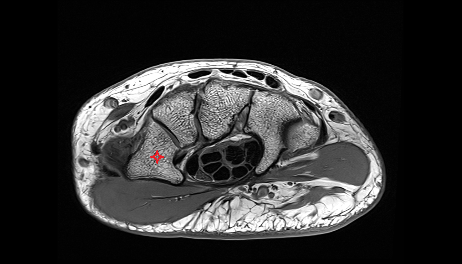 Trapezium bone axial cross sectional anatomy 3T MRI AI enhanced radiology image-img-00000-00000