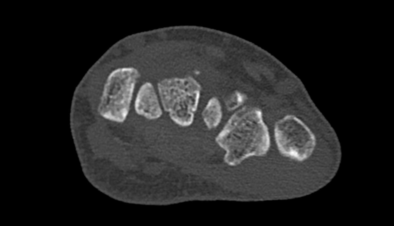 Trapezium bone ct axial