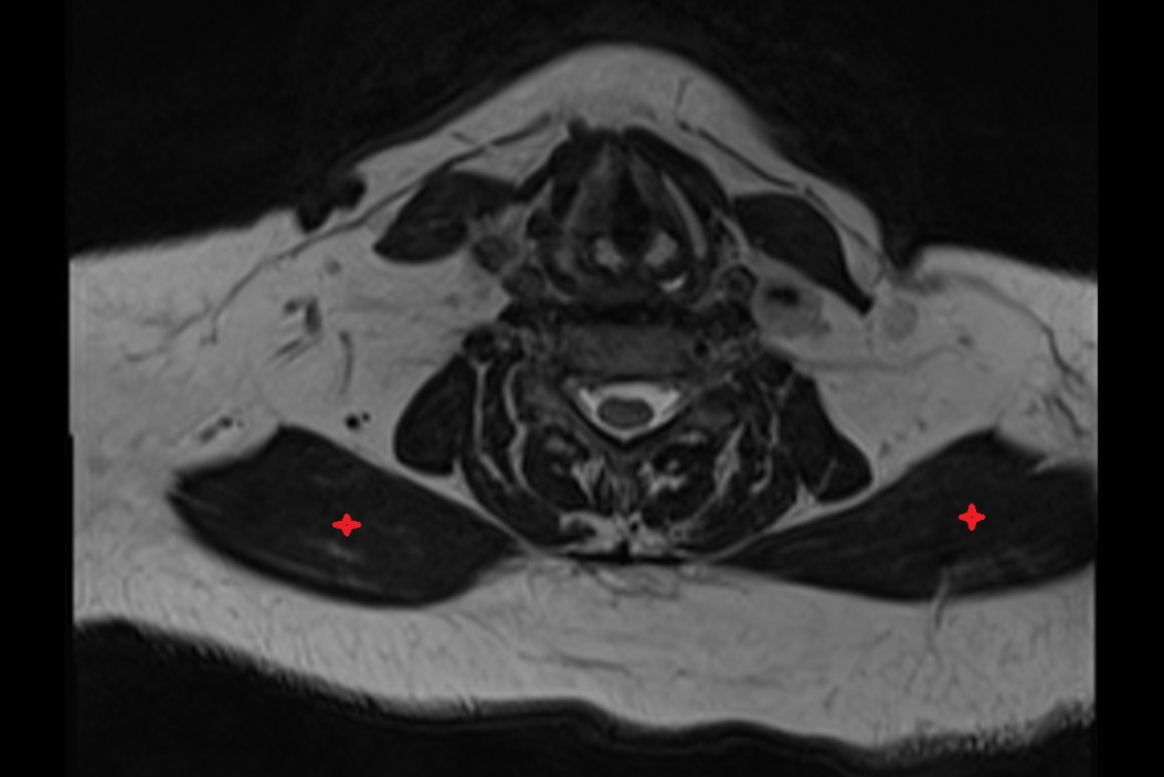 Trapezius muscle MRI AXIAL IMAGE