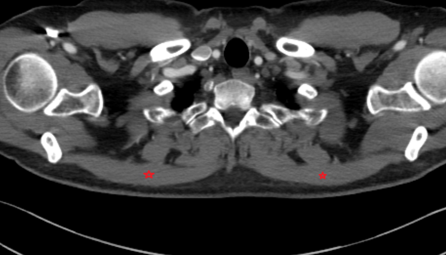 Trapezius muscle anatomy CT  axial  image -img-00000-00000