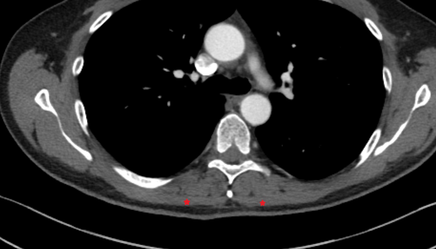 Trapezius muscle anatomy CT  axial  image -img-00000-00000_00001