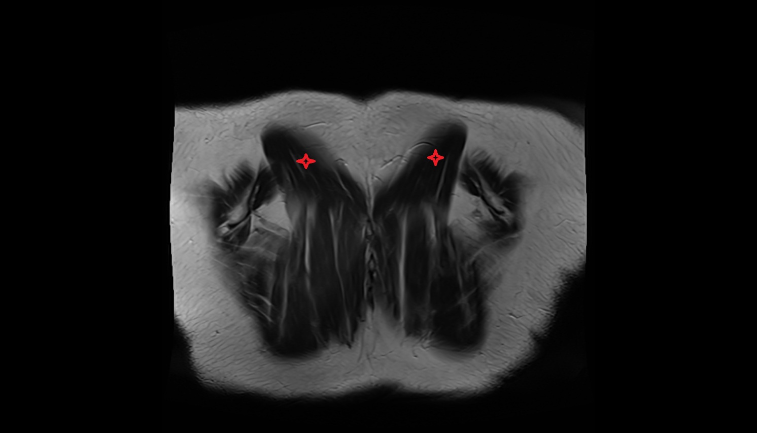 Trapezius muscle anatomy MRI coronal  image -img-00000-00000
