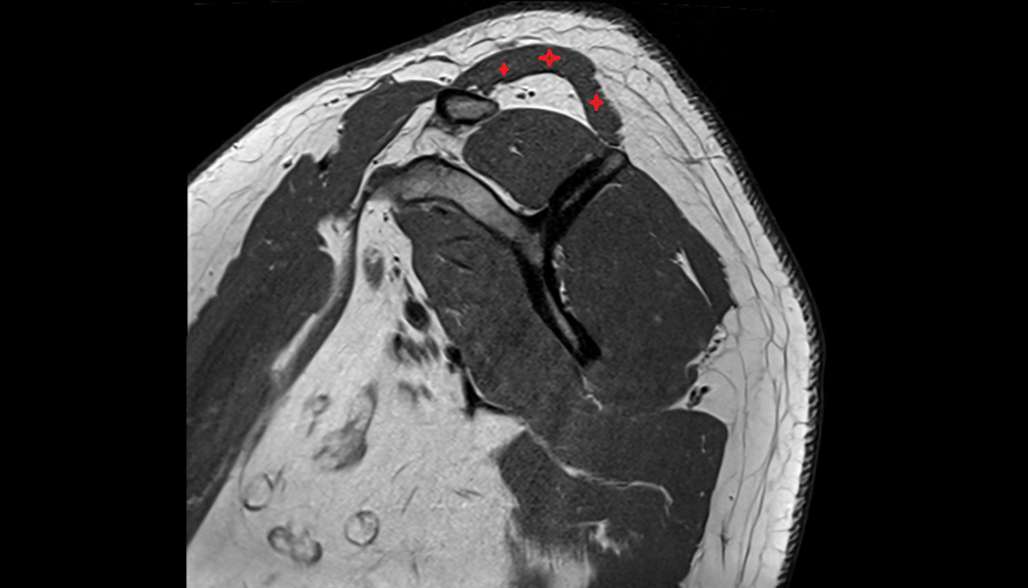 Trapezius muscle  sag cross sectional anatomy 3T MRI AI enhanced radiology image-img-00000-00000