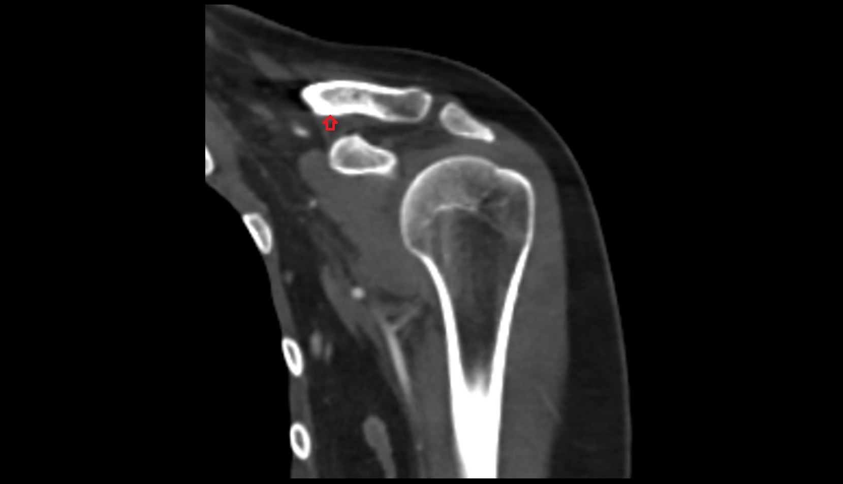 Trapezoid Line ct coronal