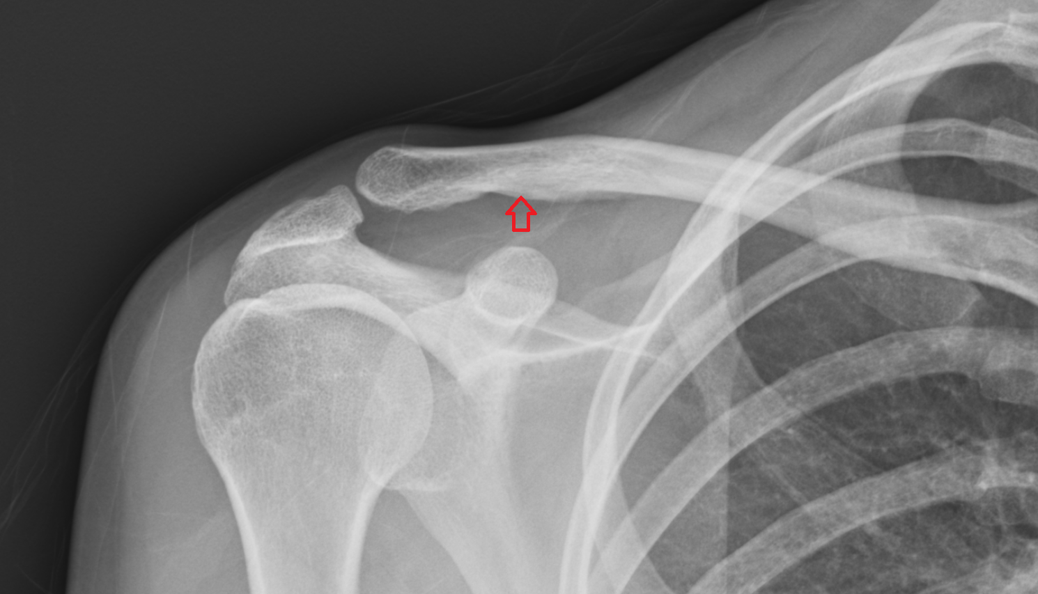 Trapezoid Line x ray  anatomy labelled image-img-00000-00000