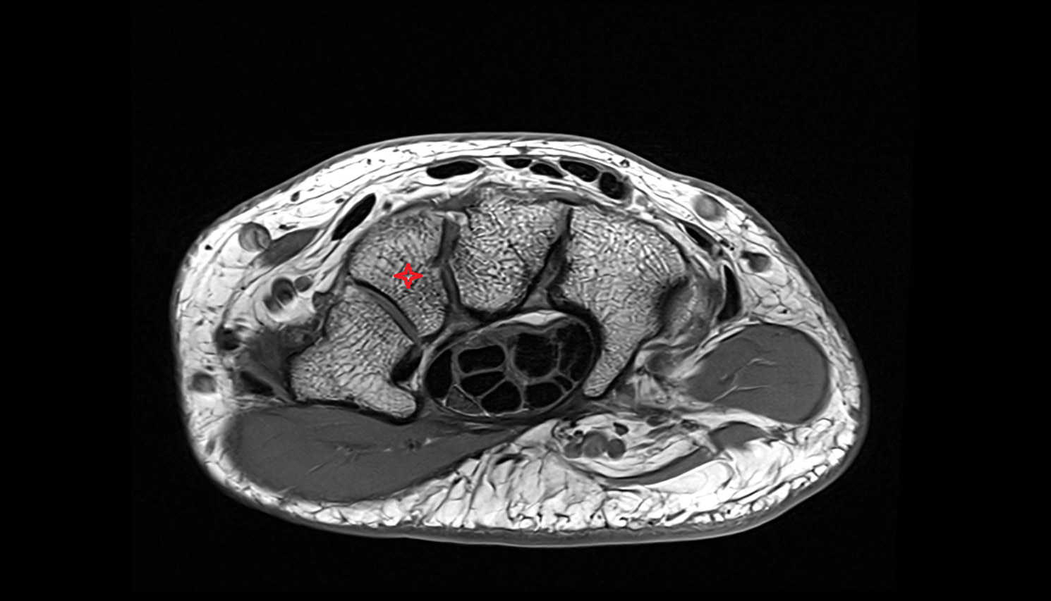 Trapezoid  bone axial cross sectional anatomy 3T MRI AI enhanced radiology image-img-00000-00000