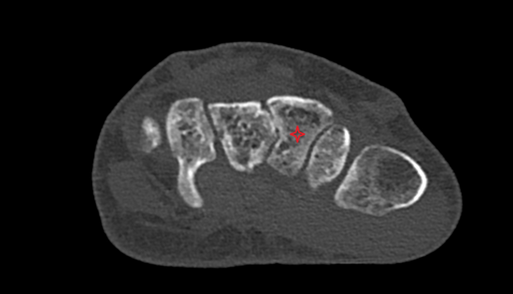 Trapezoid bone ct axial image