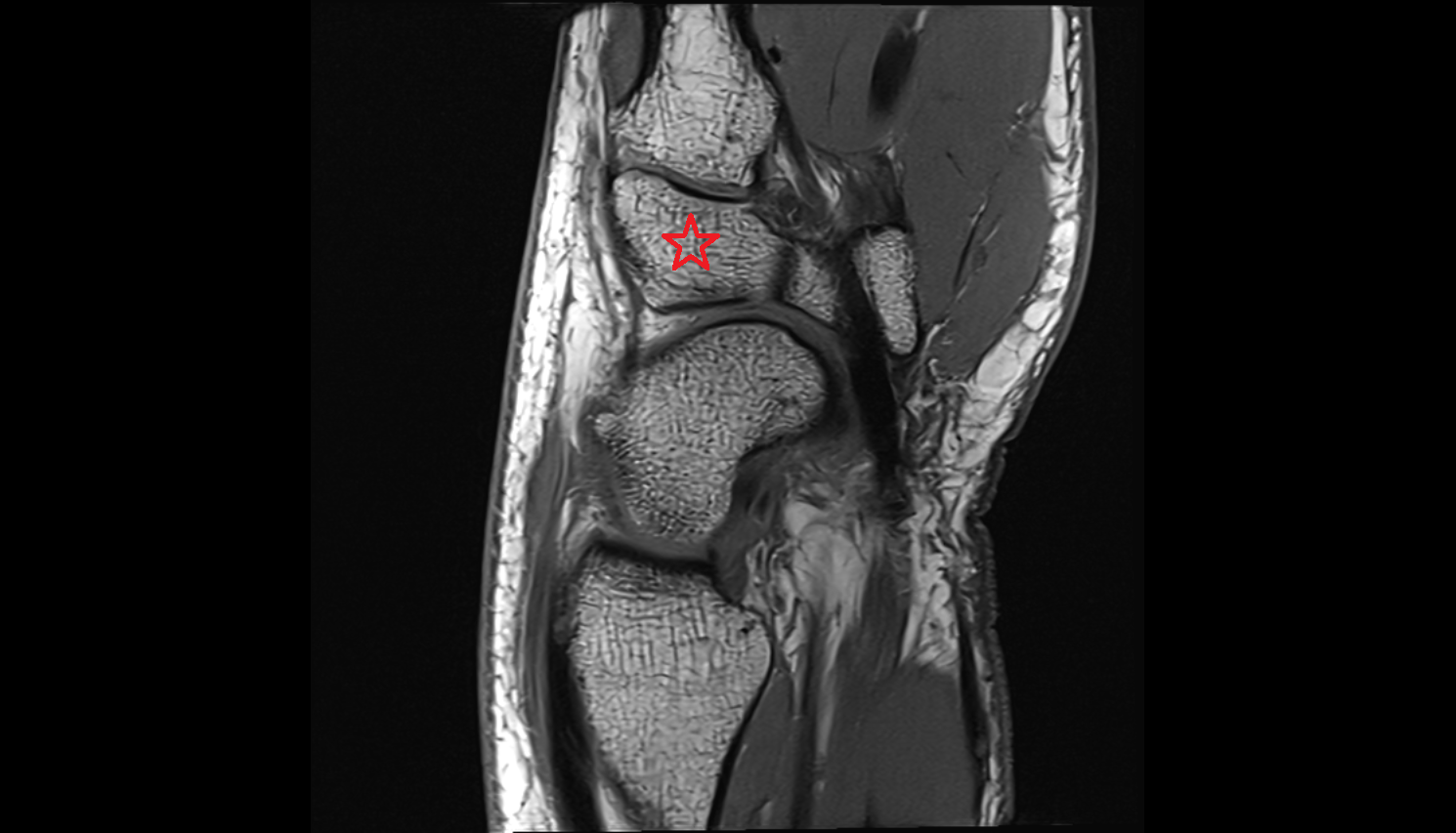 Trapezoid  bone sgital cross sectional anatomy 3T MRI AI enhanced radiology image-img-00000-00000