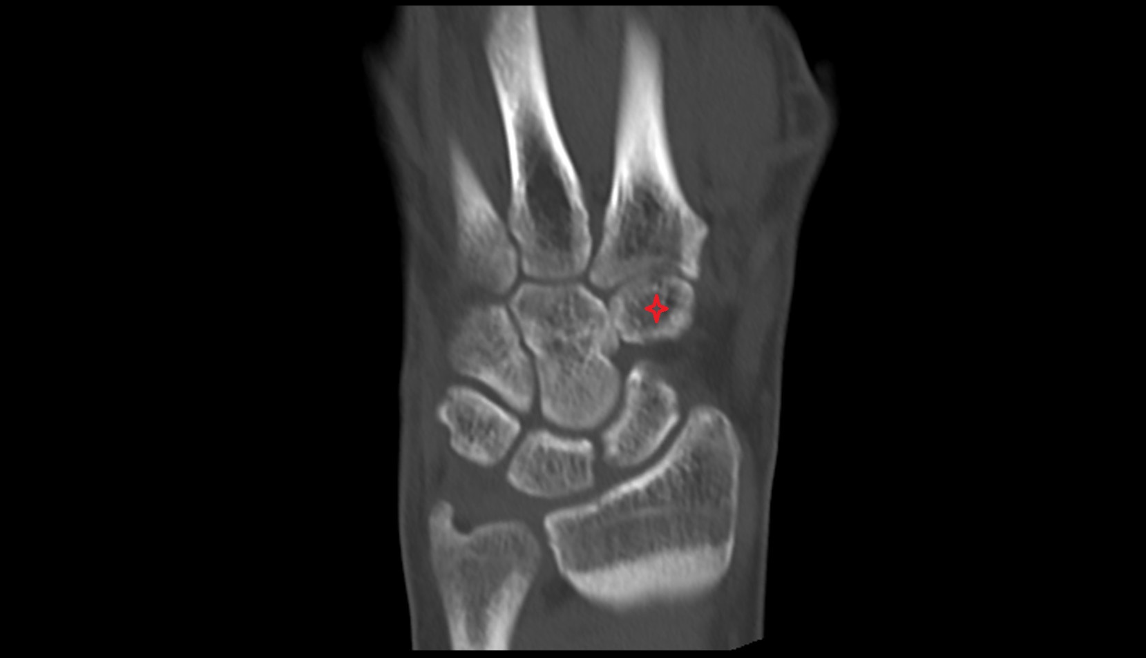 Trapezoid ct coronal image