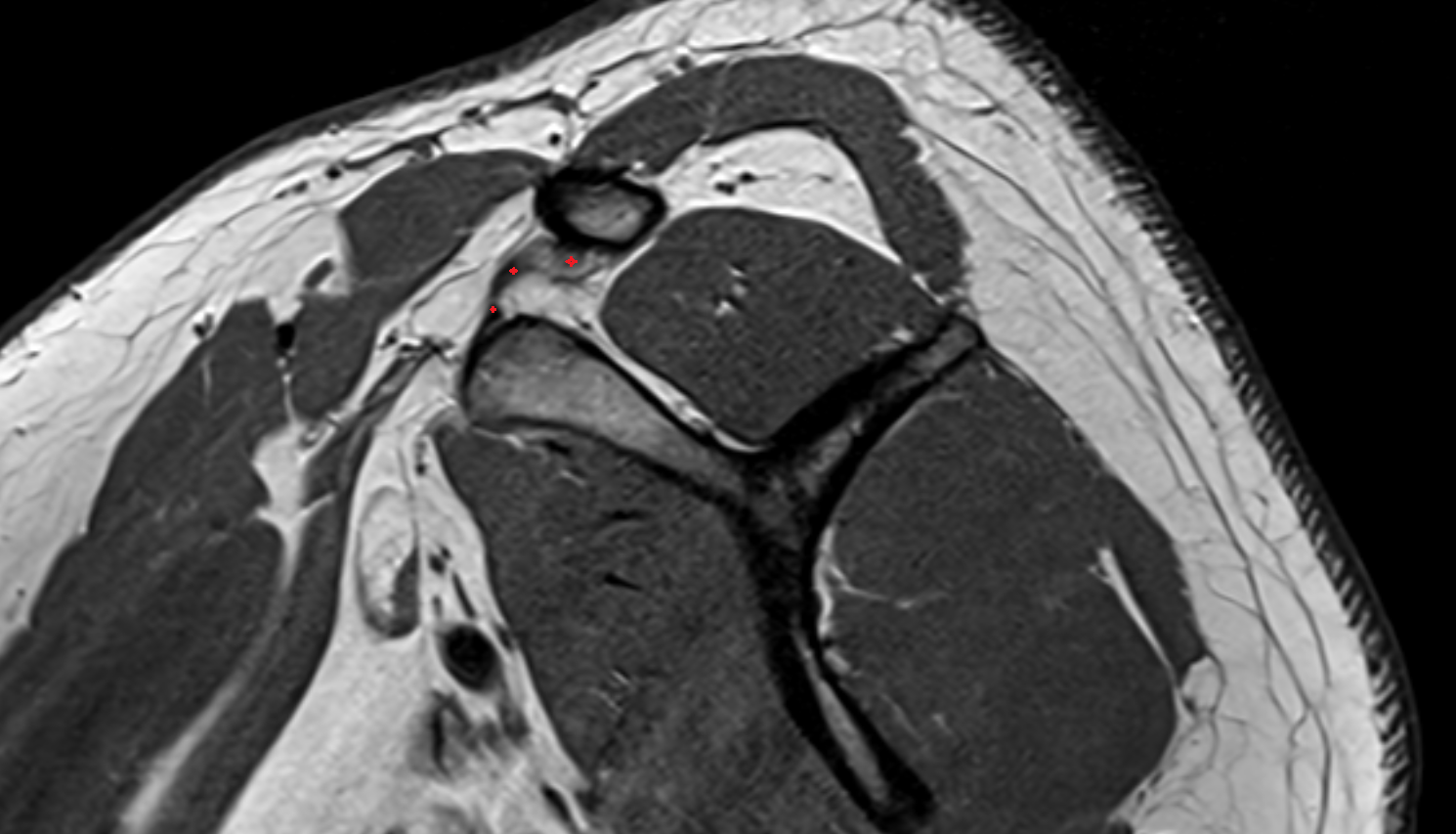 Trapezoid ligament  sag  cross sectional anatomy 3T MRI AI enhanced radiology image-img-00000-00000
