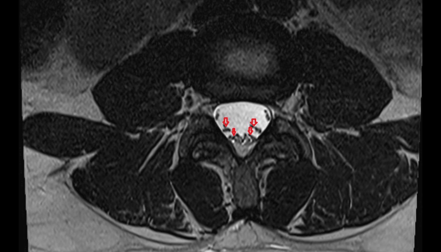 Traversing nerve root of  spinal nerve  MRI axial  anatomy  image-img-00000-00000