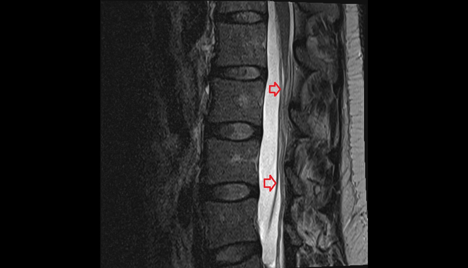 Traversing nerve root of  spinal nerve  MRI  sag anatomy  image-img-00000-00000