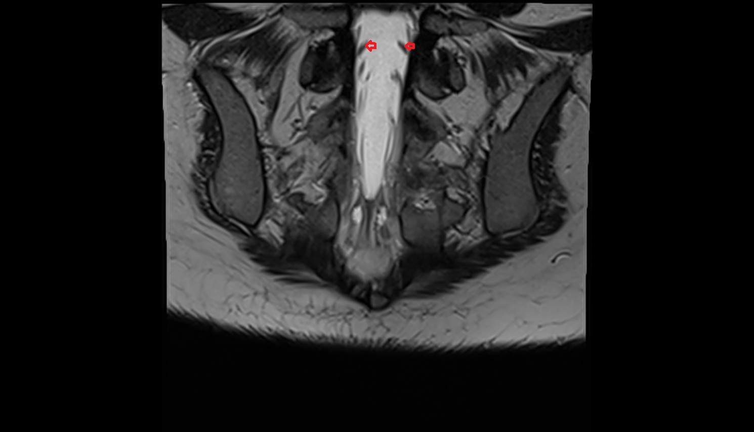 Traversing nerve root of spinal nerve S1 MRI coronal  anatomy  image-img-00000-00000