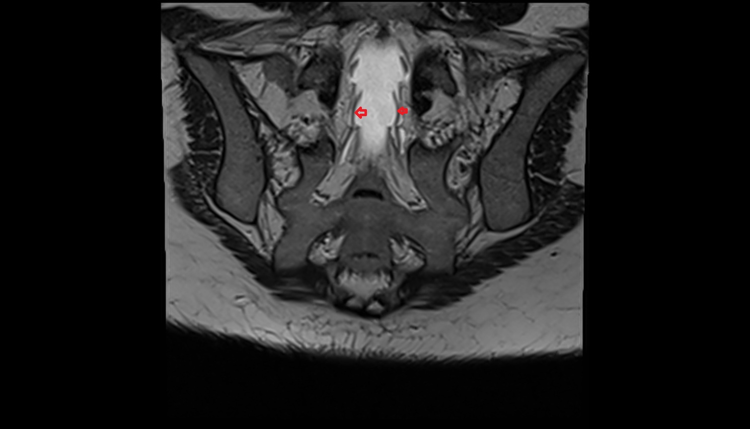 Traversing nerve root of spinal nerve S2  MRI coronal  anatomy  image-img-00000-00000