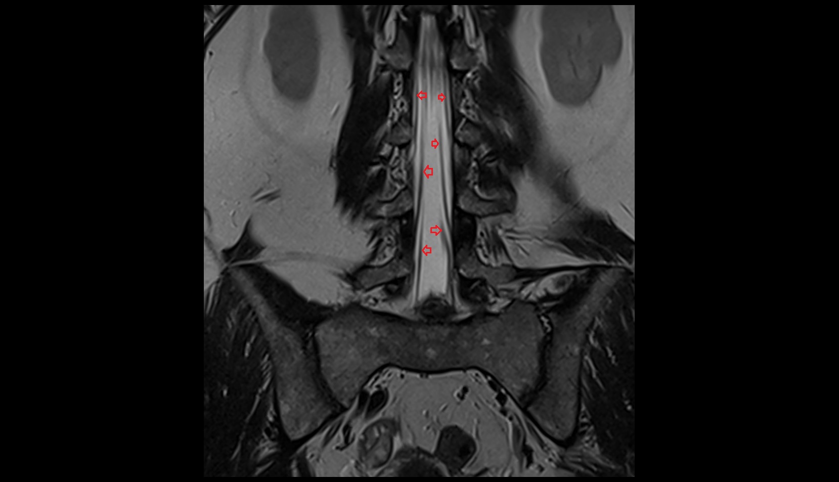 Traversing nerve root of  spinal nerve coronal mri image