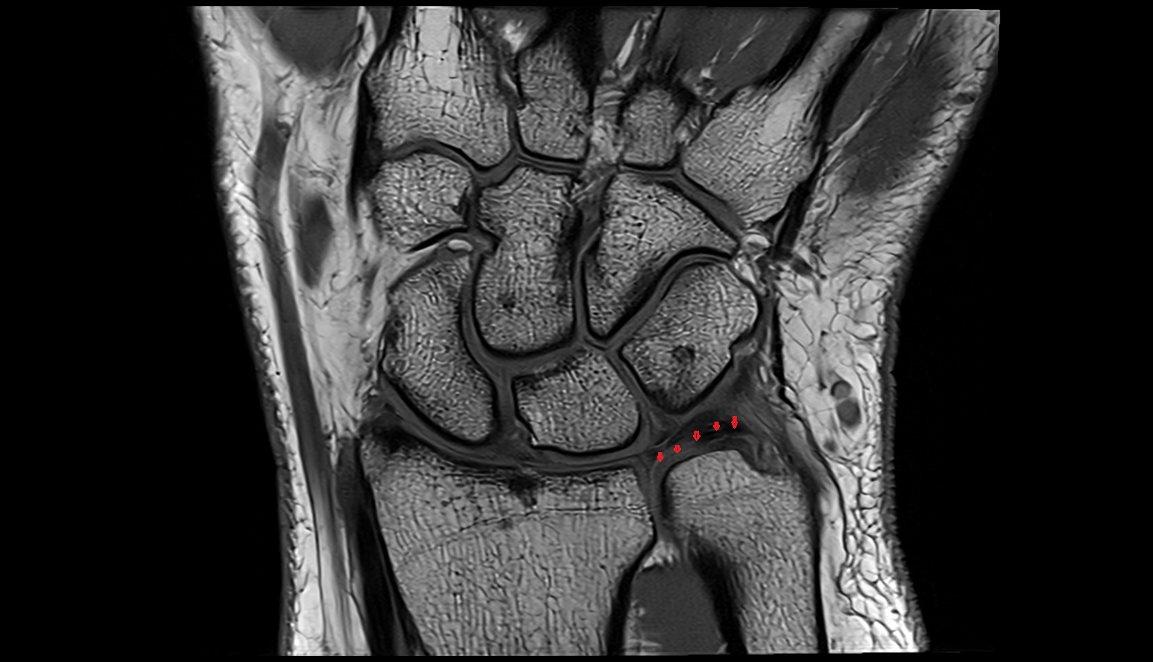 Triangular Fibrocartilage Articular Disc coronal mri image