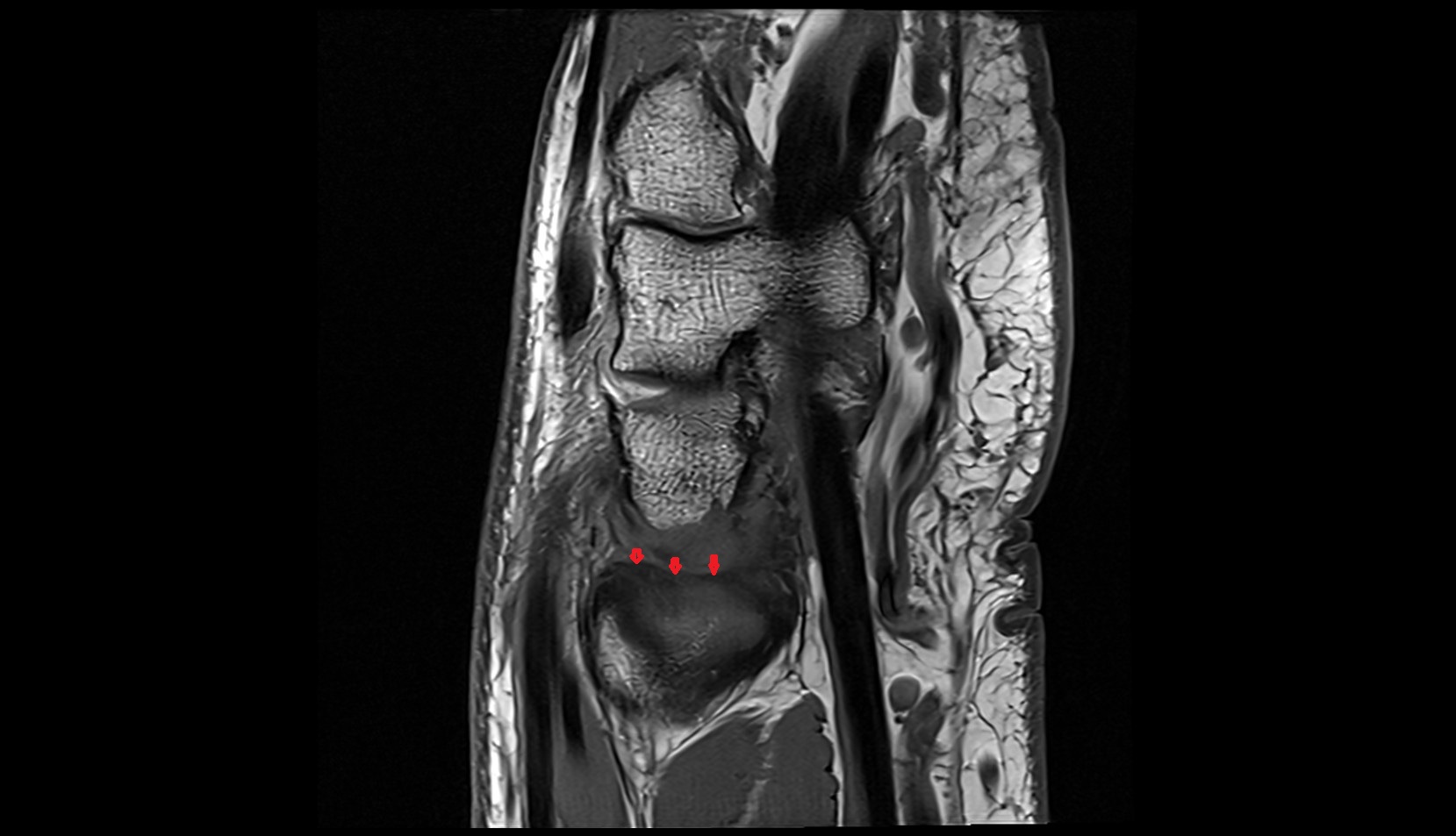 Triangular Fibrocartilage Articular Disc sag mri image