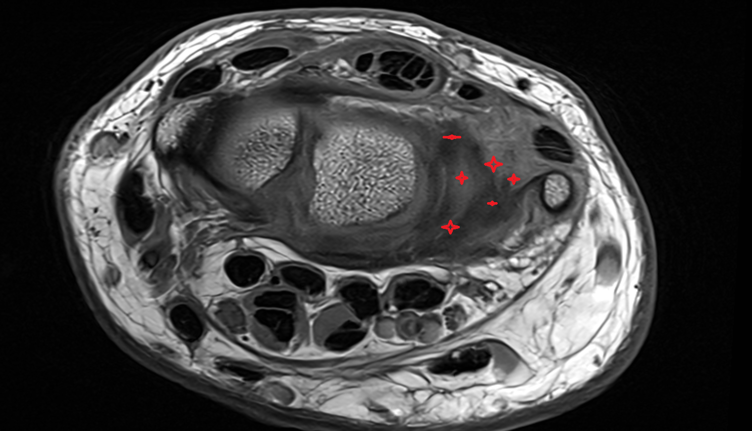 Triangular fibrocartilage complex (TFCC ) axial cross sectional anatomy 3T MRI AI enhanced radiology image-img-00000-00000