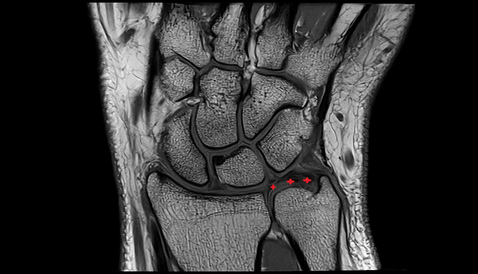 Triangular fibrocartilage complex (TFCC ) mri coronal image