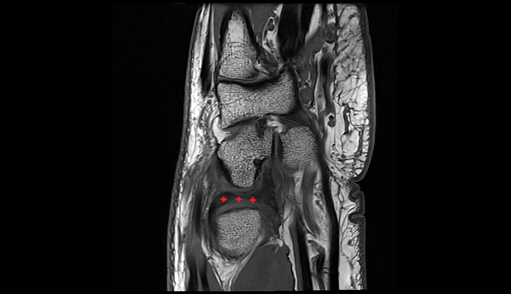 Triangular fibrocartilage complex (TFCC ) mri sagittal image