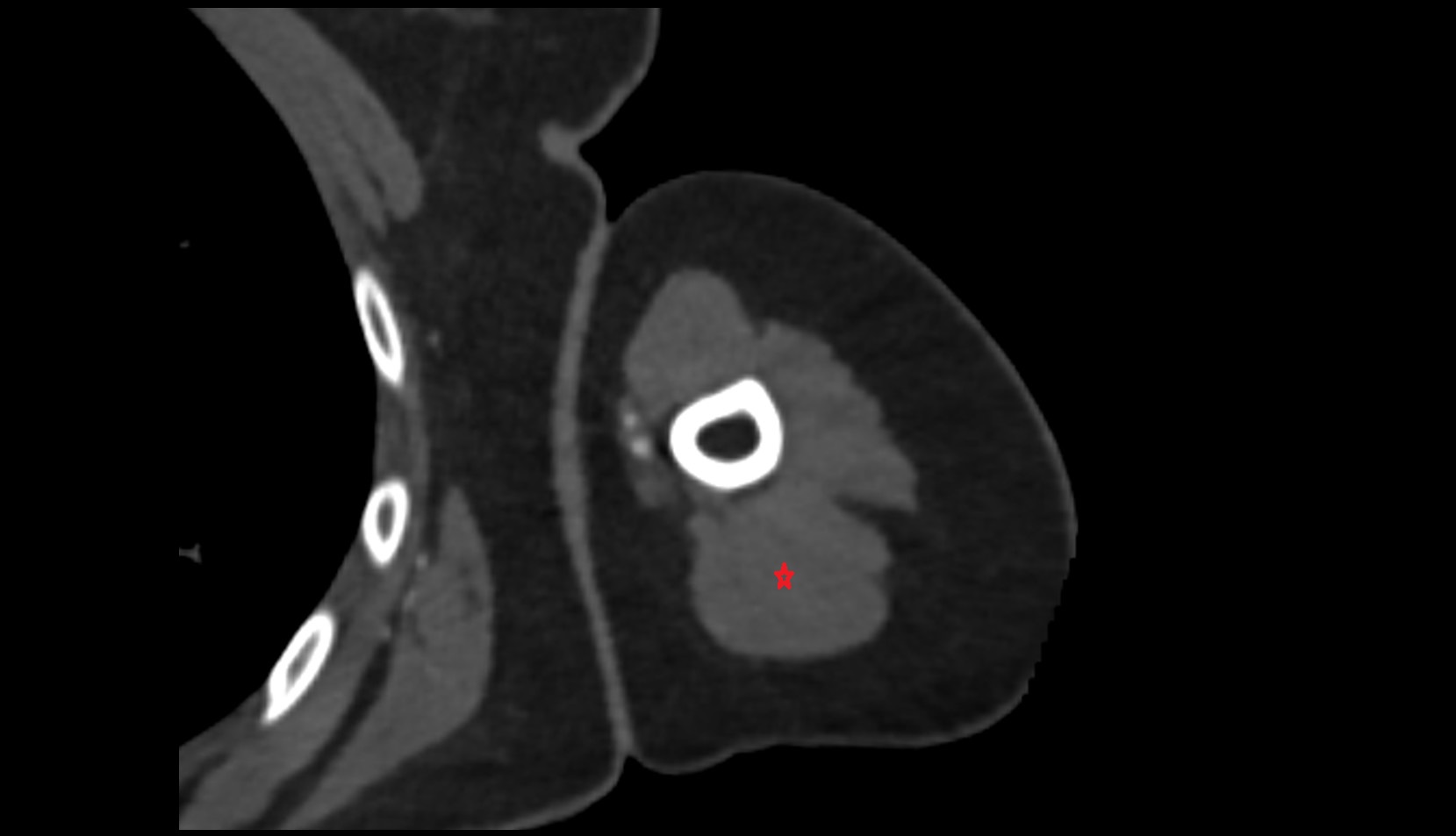 Triceps brachii muscle CT axial image  1
