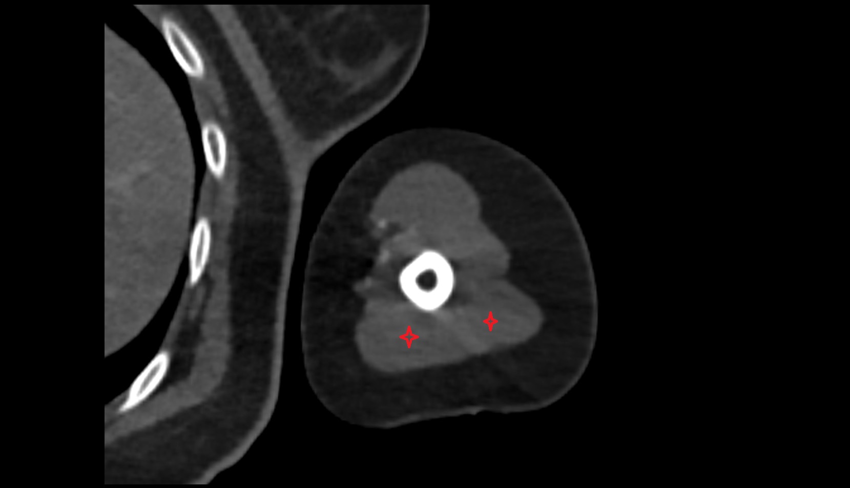Triceps brachii muscle CT axial image 2