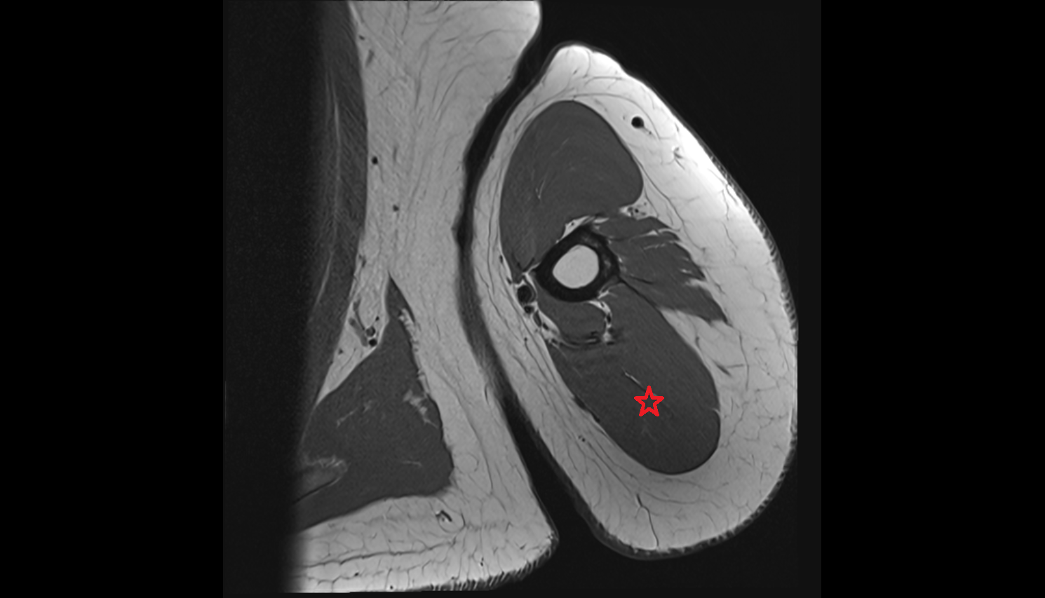 Triceps brachii muscle  axial cross sectional anatomy 3T MRI AI enhanced radiology image-img-00000-00000_00001