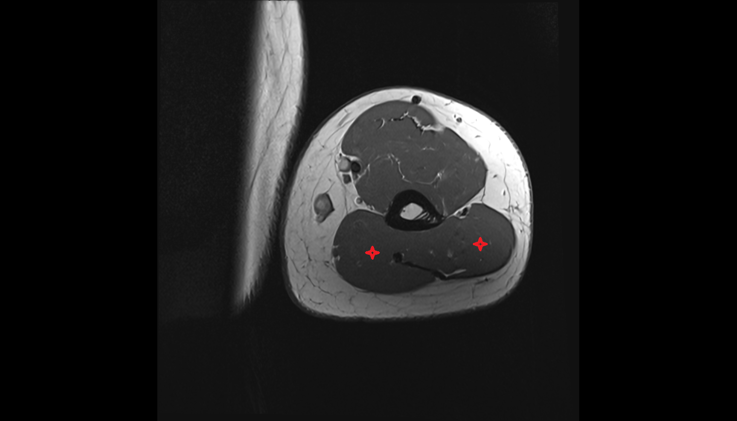 Triceps brachii muscle  axial cross sectional anatomy 3T MRI AI enhanced radiology image-img-00000-00000_00002