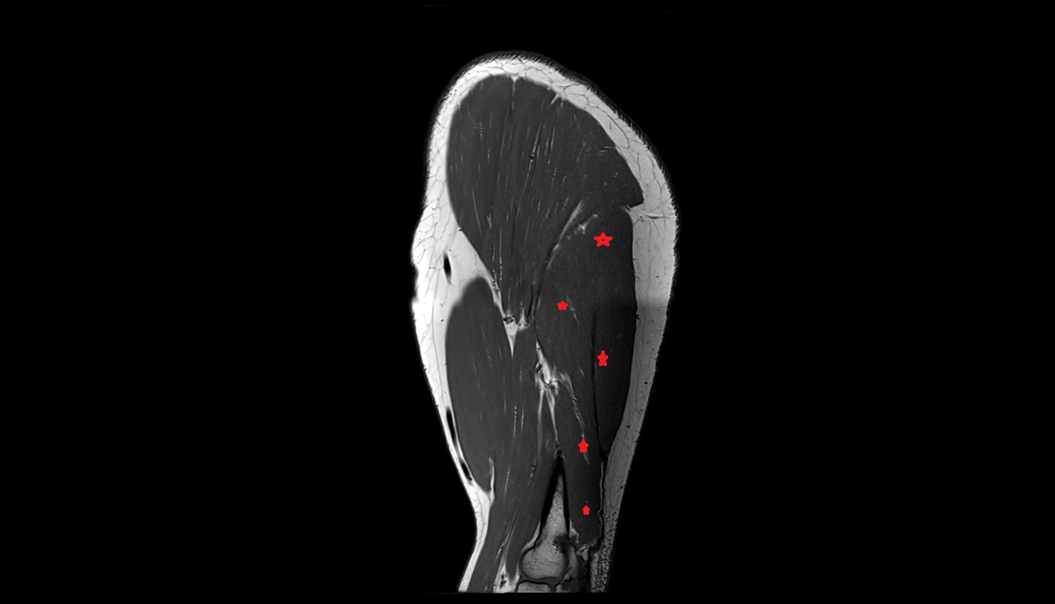 Triceps brachii muscle sag cross sectional anatomy 3T MRI AI enhanced radiology image-img-00000-00000