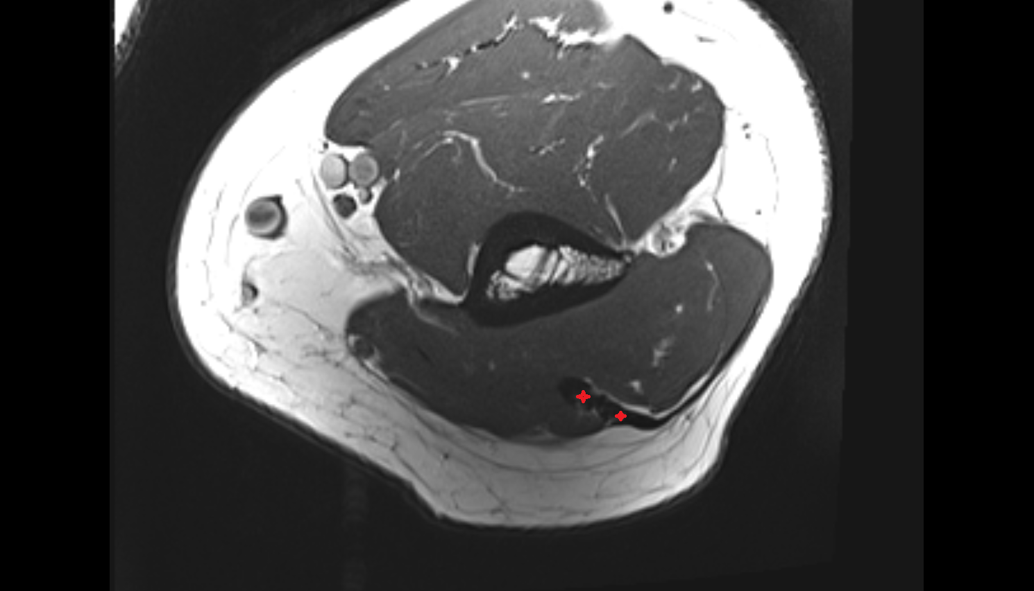 Triceps brachii tendon axial cross sectional anatomy 3T MRI AI enhanced radiology image -img-00000-00000