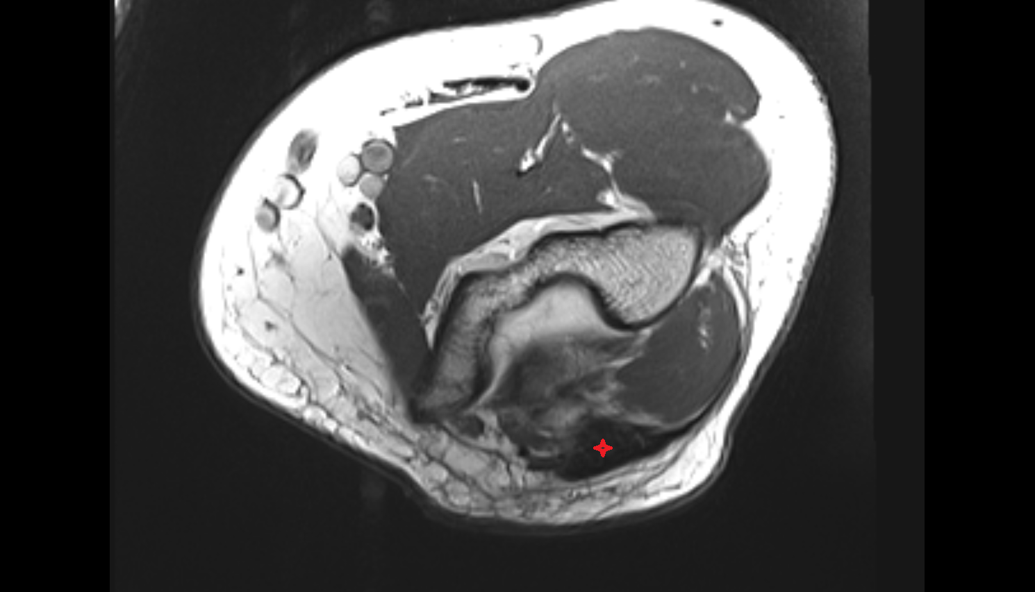 Triceps brachii tendon axial cross sectional anatomy 3T MRI AI enhanced radiology image -img-00000-00000_00001