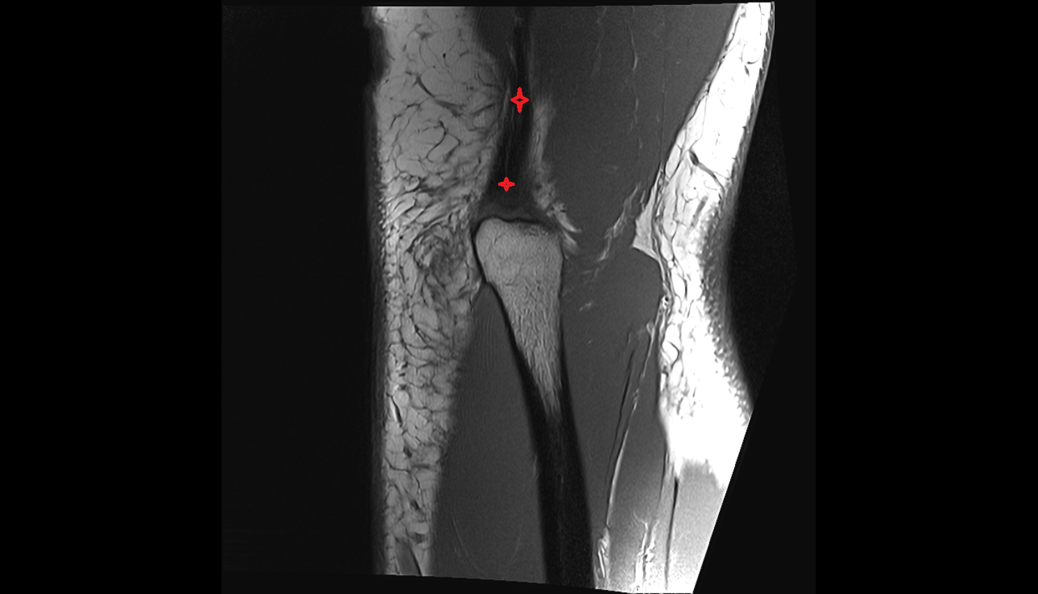 Triceps brachii tendon coronal cross sectional anatomy 3T MRI AI enhanced radiology image -img-00000-00000