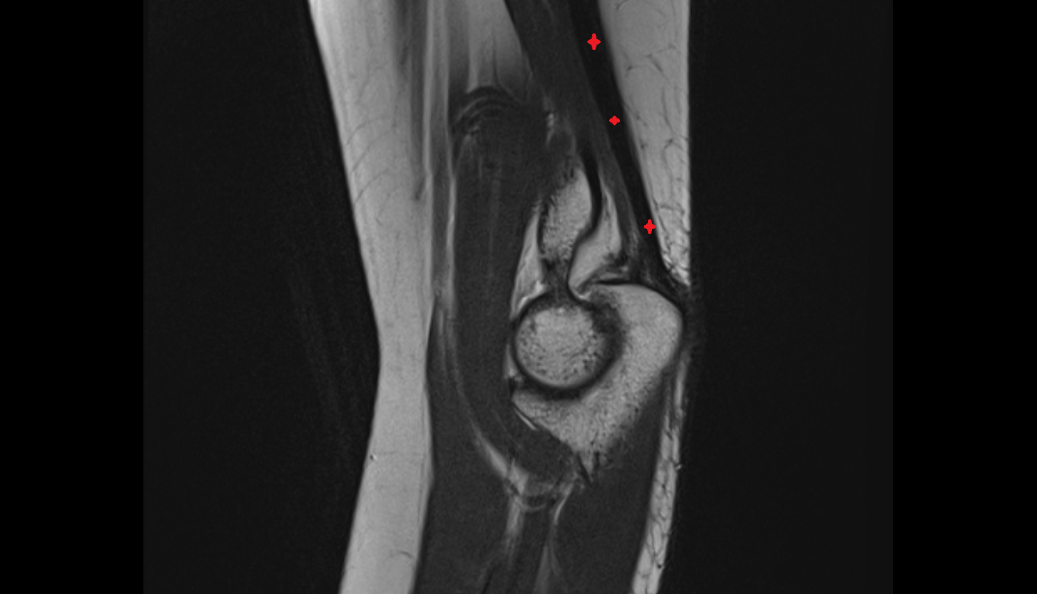Triceps brachii tendon sag cross sectional anatomy 3T MRI AI enhanced radiology image -img-00000-00000