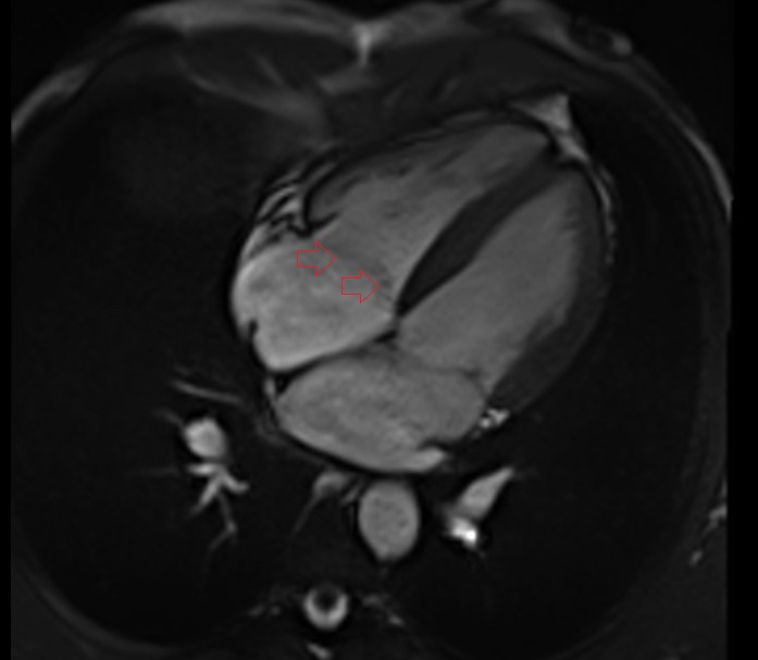 Tricuspid valve, Right atrioventricular valve