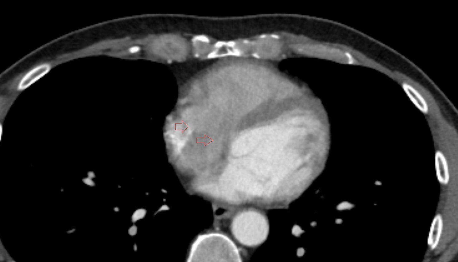 Tricuspid valve, Right atrioventricular valve  ct AXIAL  image -img-00000-00000