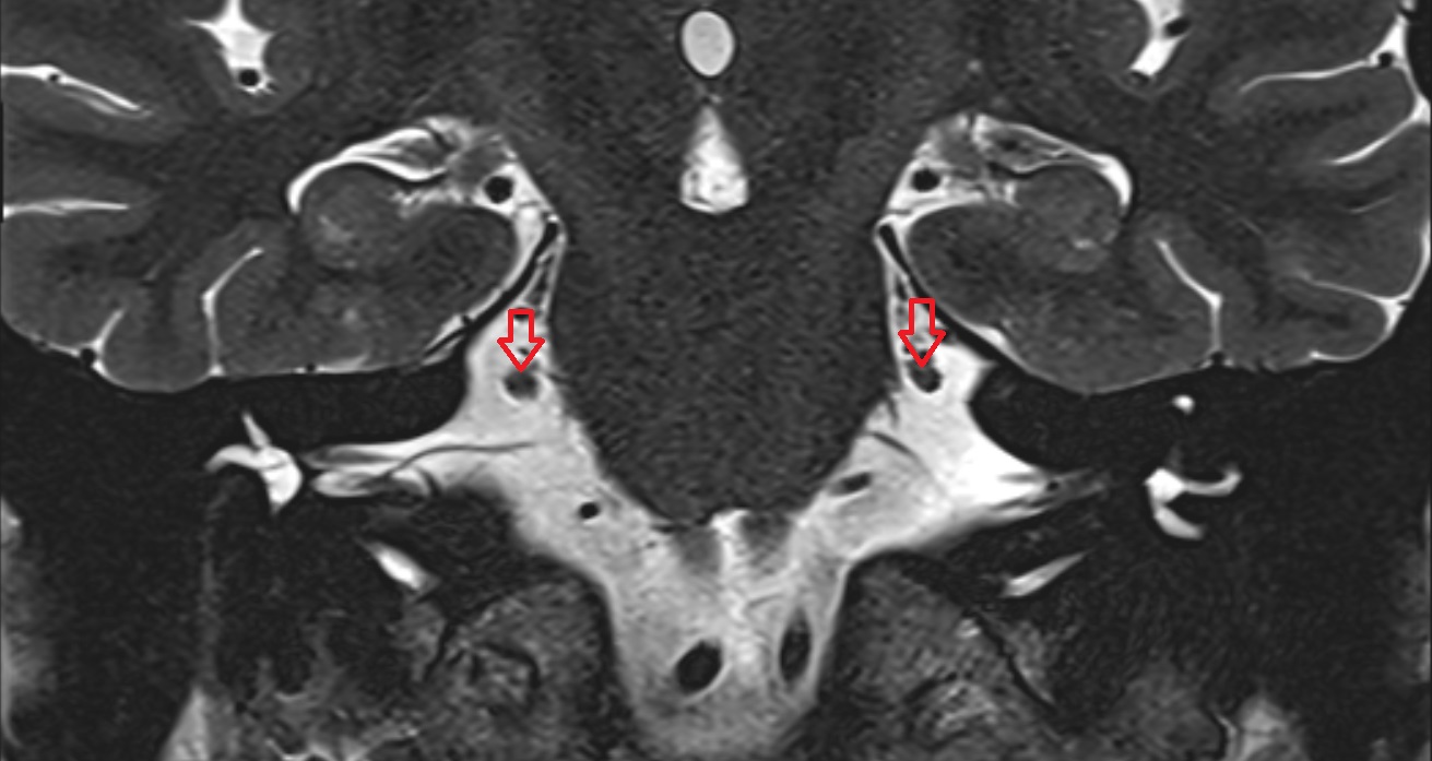 Trigeminal Nerve (Cranial Nerve V)  MRI coronal anatomy image -img-00001-00001