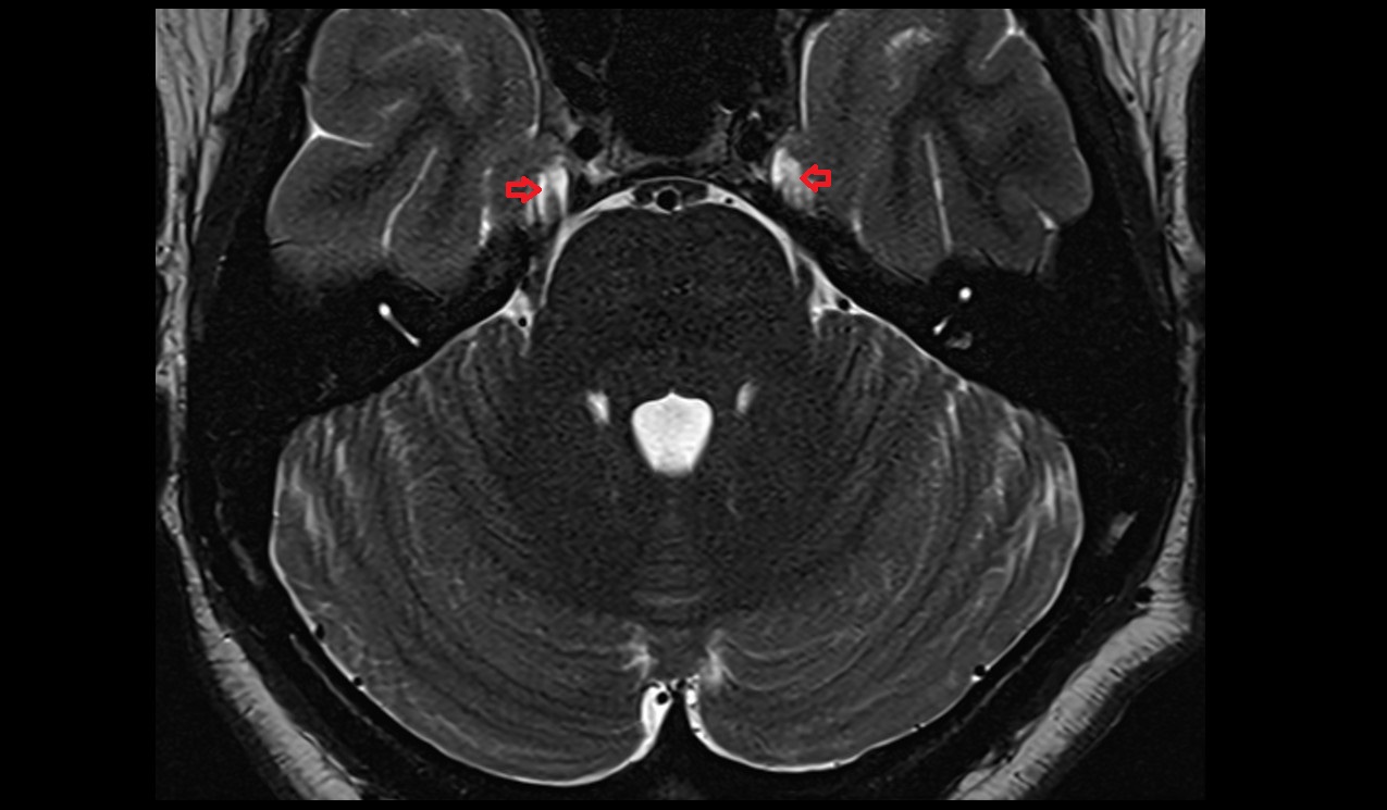 Trigeminal cavity (Meckel) mri 3t axial image