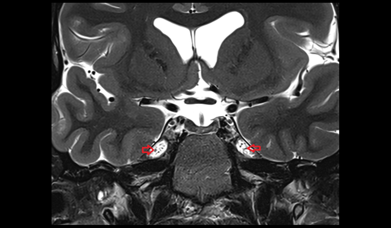 Trigeminal cavity (Meckel) mri 3t  coronal image